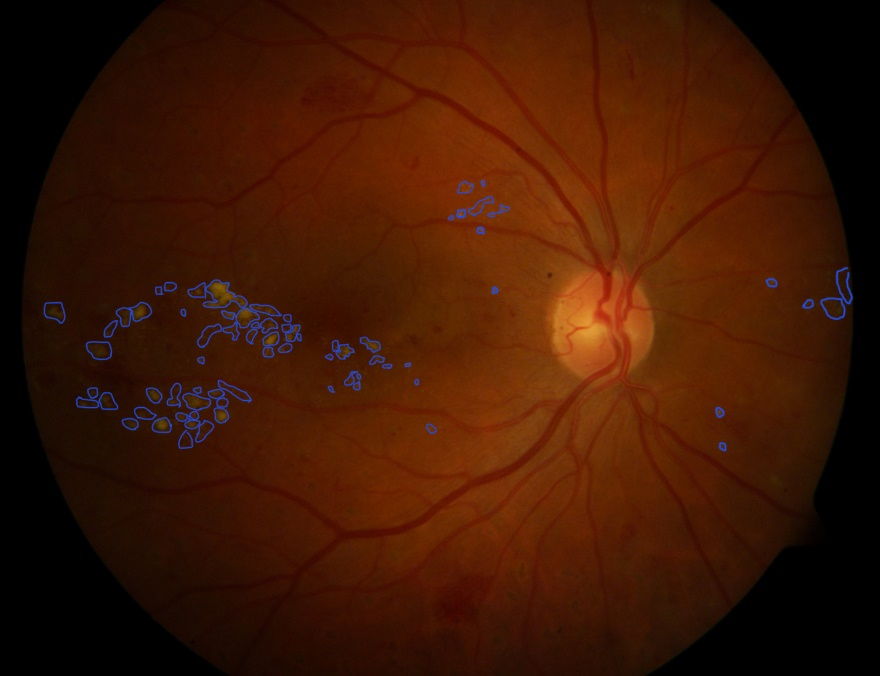 A fundus image of a retina, with damaged areas highlighted by the image-processing algorithm.